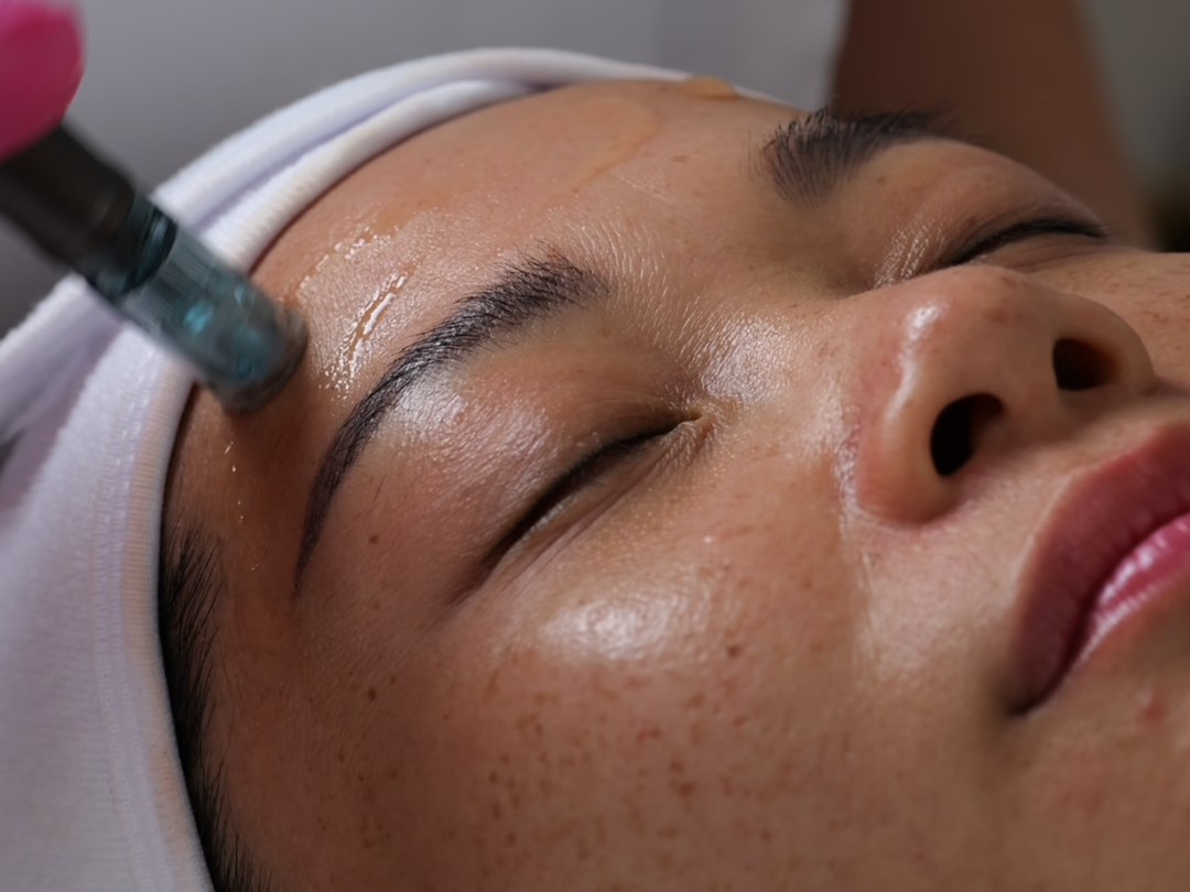 Microneedling-behandling med microneedling-penna