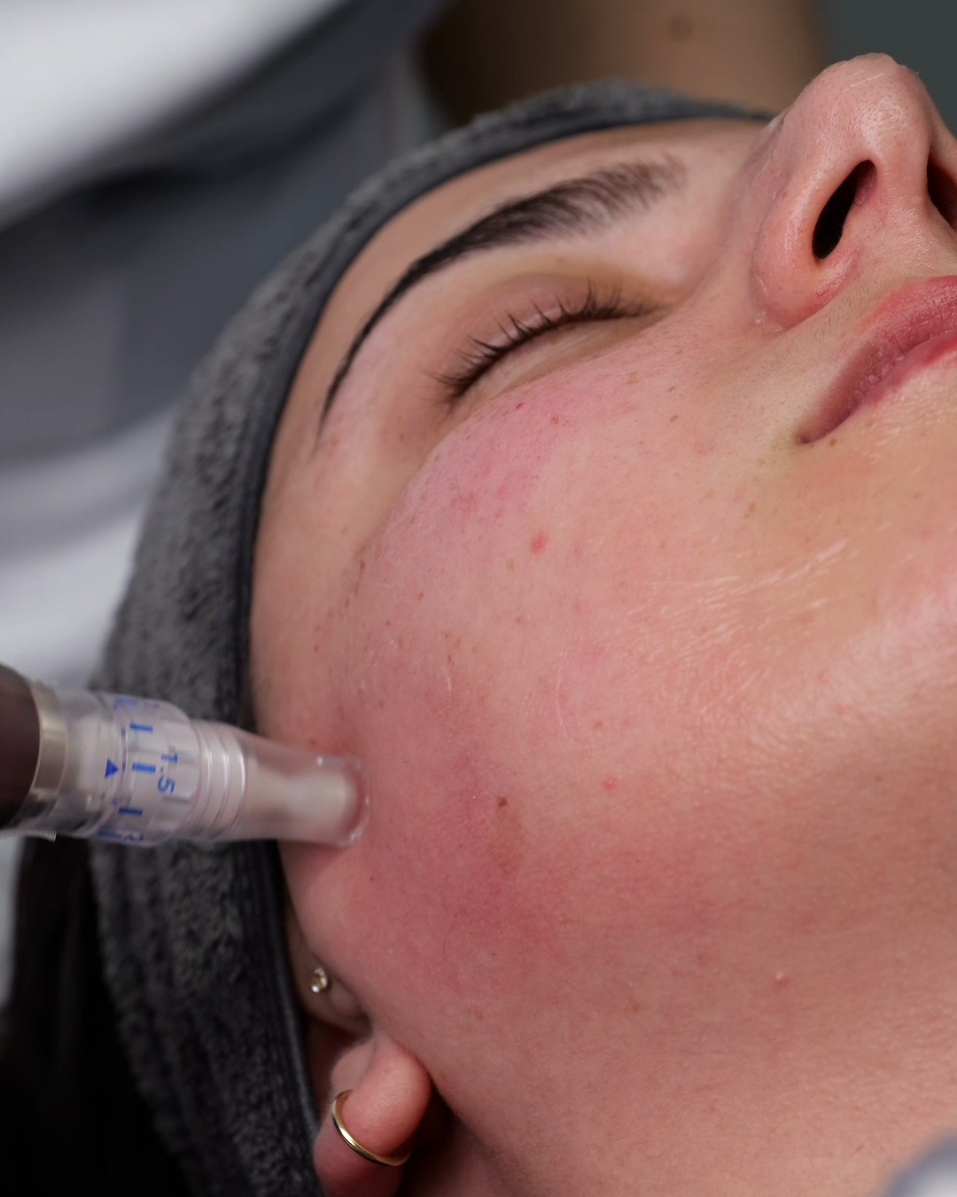 Microneedling-penna mot kinden under behandlingen